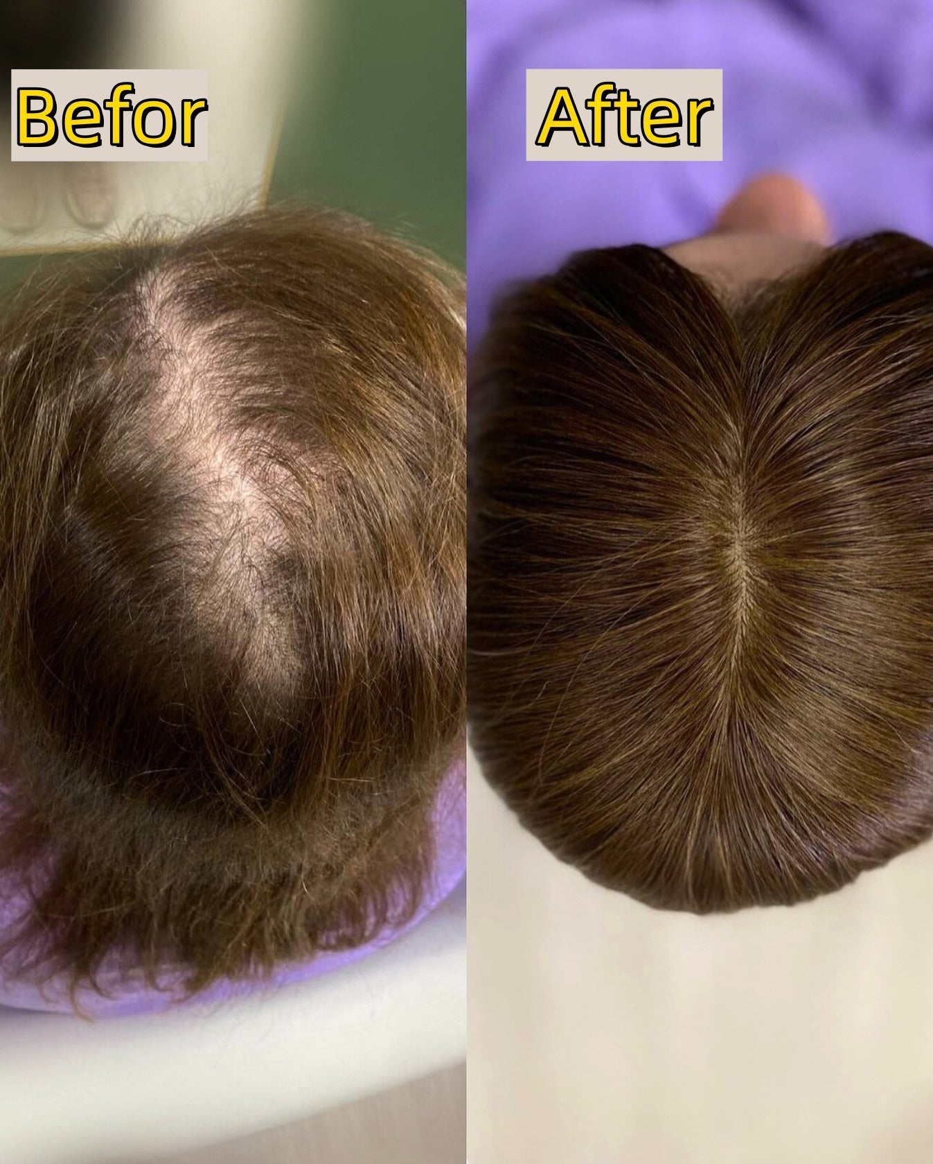 Straight Hair Topper for Crown Thinning – Natural Coverage at the Crown